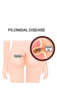 dr dhawale services pilonidal sinus 01