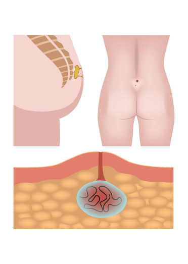dr dhawale services pilonidal sinus 02