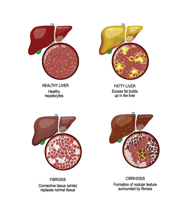 dr dhawale homeopathy services liver cirrhosis img 02